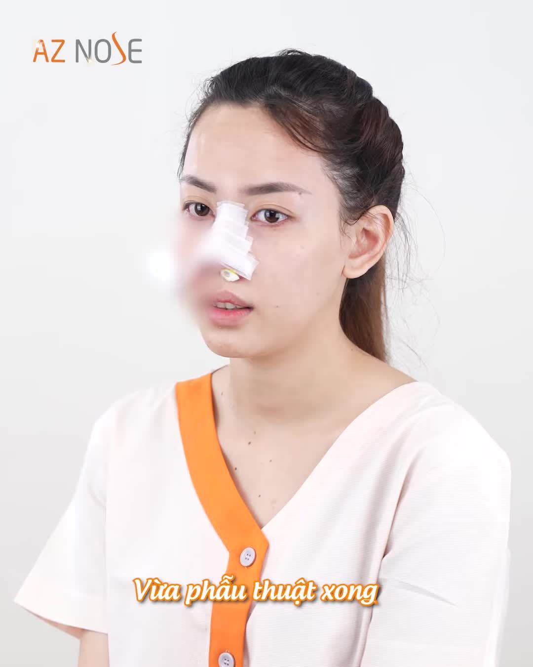 Ước mơ "tạm biệt mũi t.ẹt" trở thành sự thật sau 1 tháng phẫu thuật